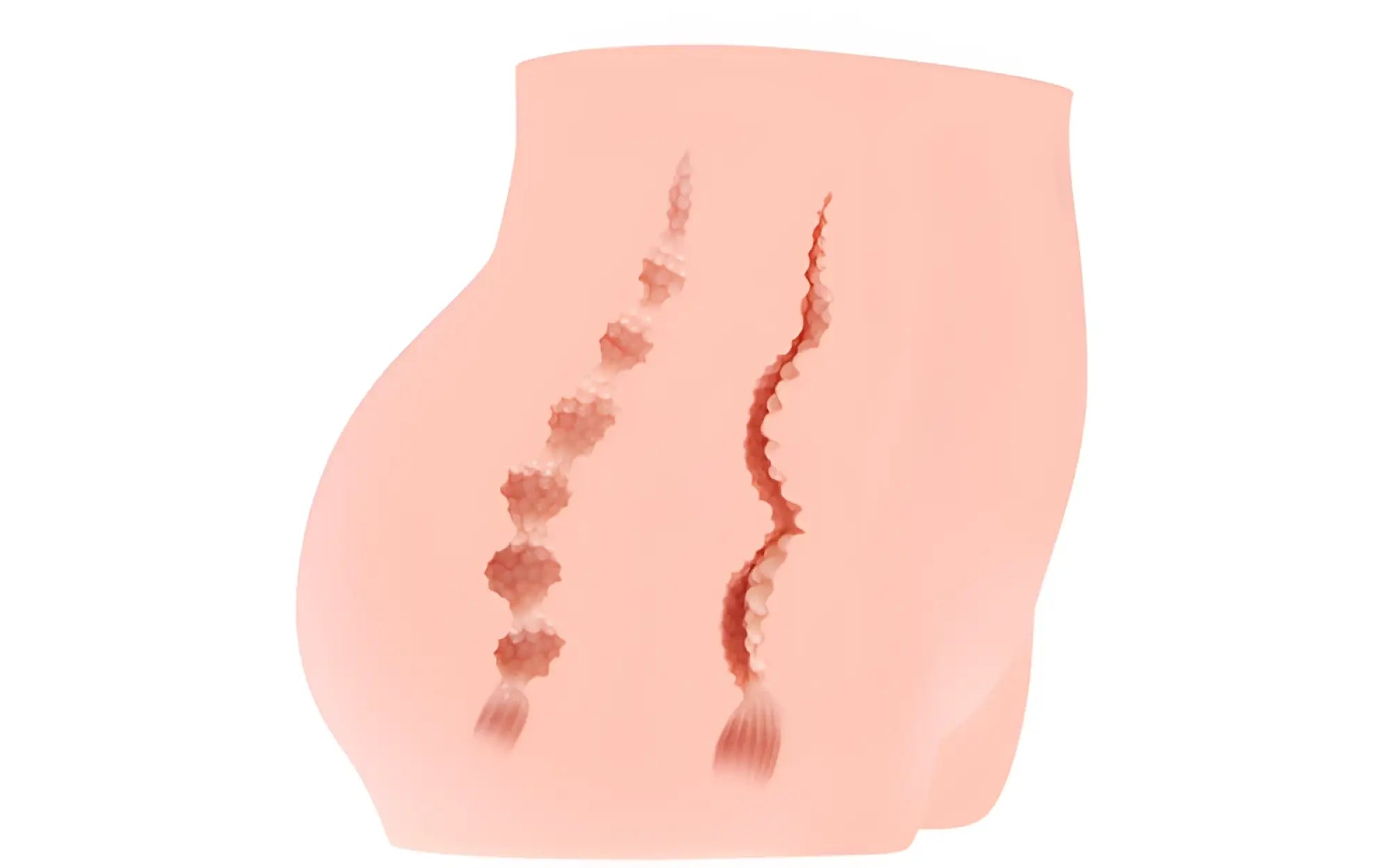 A stylized illustration of a human torso with vertical reddish brown scar markings for Kokos real hip cherry